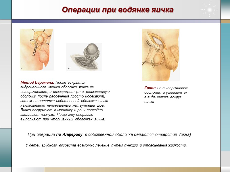 Операции при водянке яичка  При операции по Алферову в собственной оболочке делаются отверстия